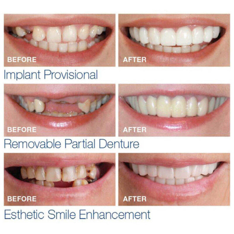 Xshopz Perfect Instant Smile Teeth Veneers Uppers Lowers