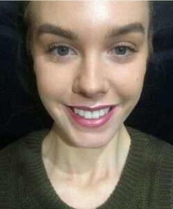 Snap on smile customer - Kim B