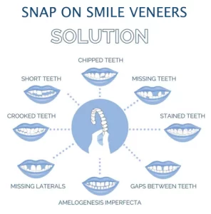 Snap On Smile Teeth Veneers Solutions