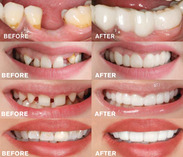 Snap-On Smile Teeth Veneers before after
