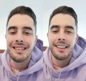 Snap-On Smile Teeth Veneers for Perfect Smile