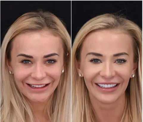 Snap on smile teeth veneers Customer before and after