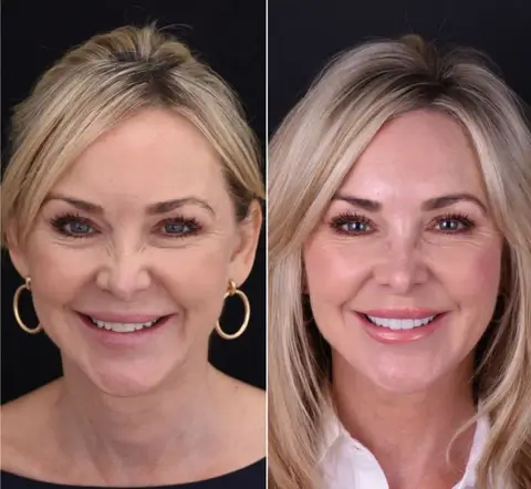 Snap on smile teeth veneers Customer before and after