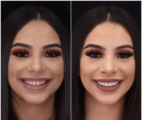 Snap on smile teeth veneers Customer before and after