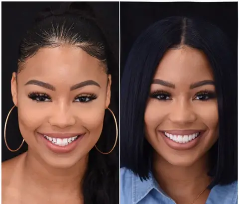 Snap on smile teeth veneers Customer before and after