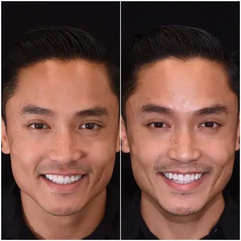 Snap on smile teeth veneers Customer before and after