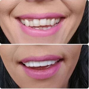 Snap-On Smile Teeth Veneers photo review